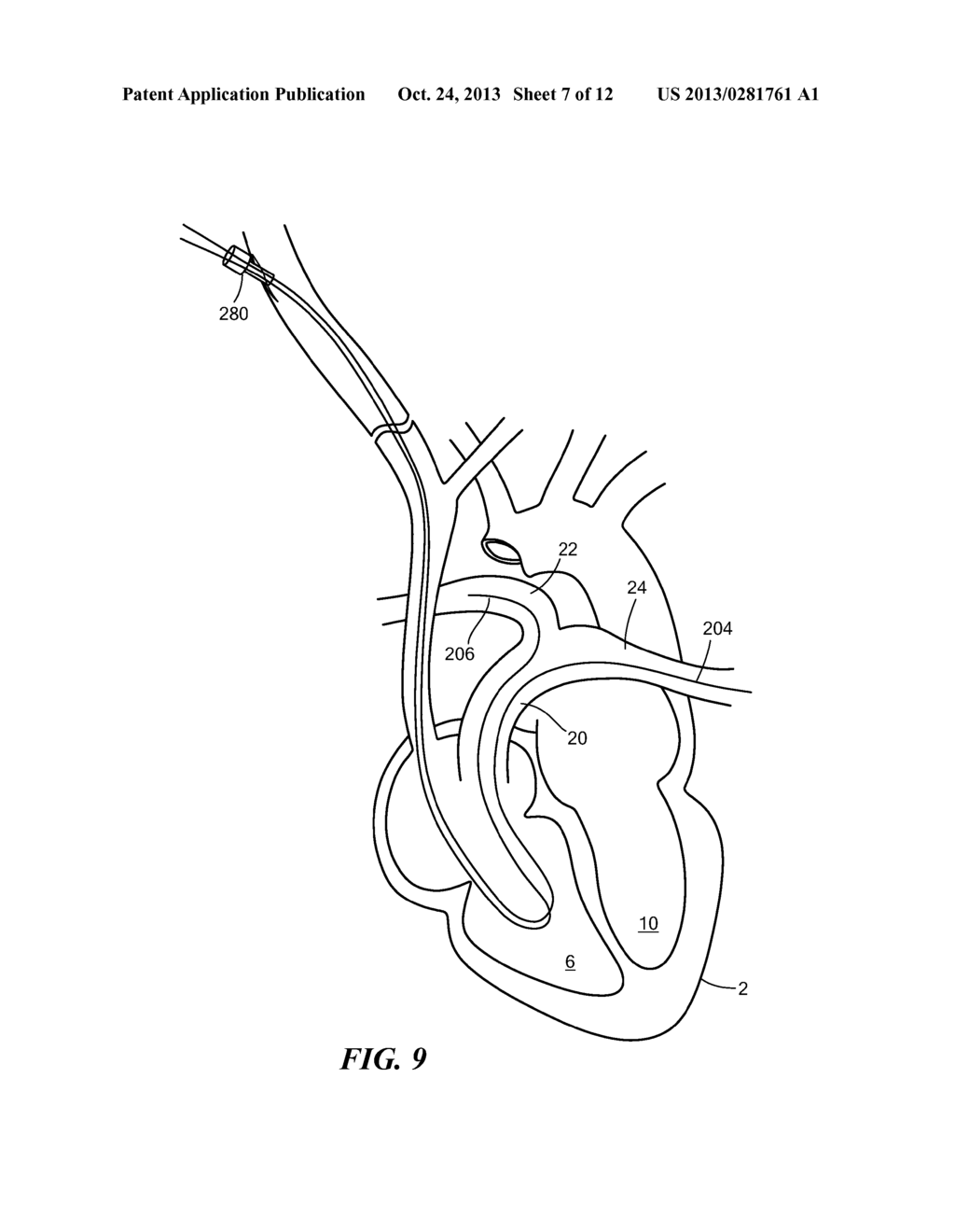 CANNULA WITH BIFURCATED TIP FOR A CARDIAC ASSIST DEVICE - diagram, schematic, and image 08