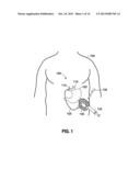 IMPLANTABLE ACCESS PORT SYSTEM diagram and image