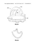 IMPLANTABLE ACCESS PORT SYSTEM diagram and image