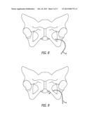 Implants And Procedures For Treatment Of  Pelvic Floor Disorders diagram and image