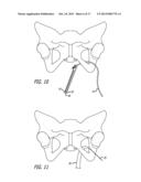 Implants And Procedures For Treatment Of  Pelvic Floor Disorders diagram and image