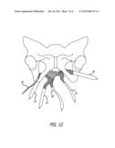 Implants And Procedures For Treatment Of  Pelvic Floor Disorders diagram and image