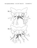 Implants And Procedures For Treatment Of  Pelvic Floor Disorders diagram and image