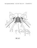 Implants And Procedures For Treatment Of  Pelvic Floor Disorders diagram and image