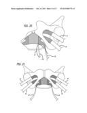 Implants And Procedures For Treatment Of  Pelvic Floor Disorders diagram and image