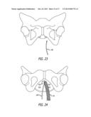 Implants And Procedures For Treatment Of  Pelvic Floor Disorders diagram and image