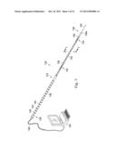 MEASUREMENT AND RESULTING COMPENSATION OF INTRAMEDULLARY NAIL DEFORMATION diagram and image