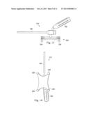 MEASUREMENT AND RESULTING COMPENSATION OF INTRAMEDULLARY NAIL DEFORMATION diagram and image