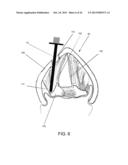 DEVICES AND METHODS FOR ANTERIOR ARYTENOID ADDUCTION diagram and image