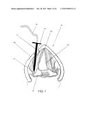 DEVICES AND METHODS FOR ANTERIOR ARYTENOID ADDUCTION diagram and image