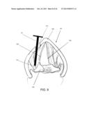 DEVICES AND METHODS FOR ANTERIOR ARYTENOID ADDUCTION diagram and image