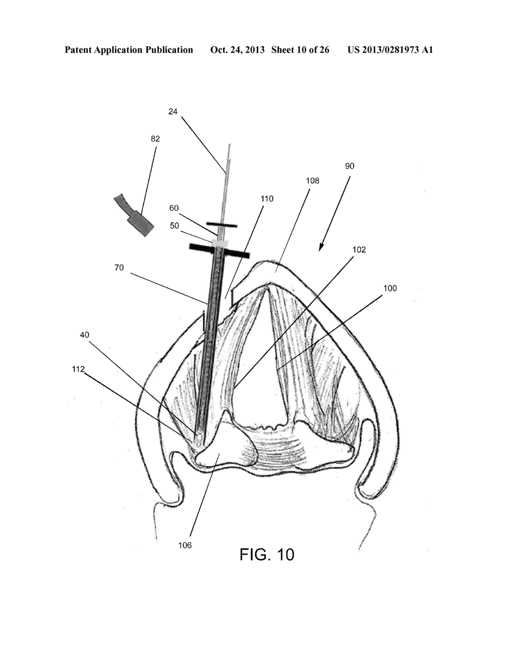 DEVICES AND METHODS FOR ANTERIOR ARYTENOID ADDUCTION - diagram, schematic, and image 11