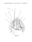 DEVICES AND METHODS FOR ANTERIOR ARYTENOID ADDUCTION diagram and image