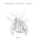 DEVICES AND METHODS FOR ANTERIOR ARYTENOID ADDUCTION diagram and image