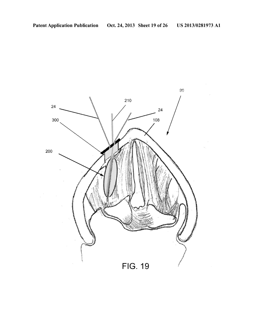 DEVICES AND METHODS FOR ANTERIOR ARYTENOID ADDUCTION - diagram, schematic, and image 20