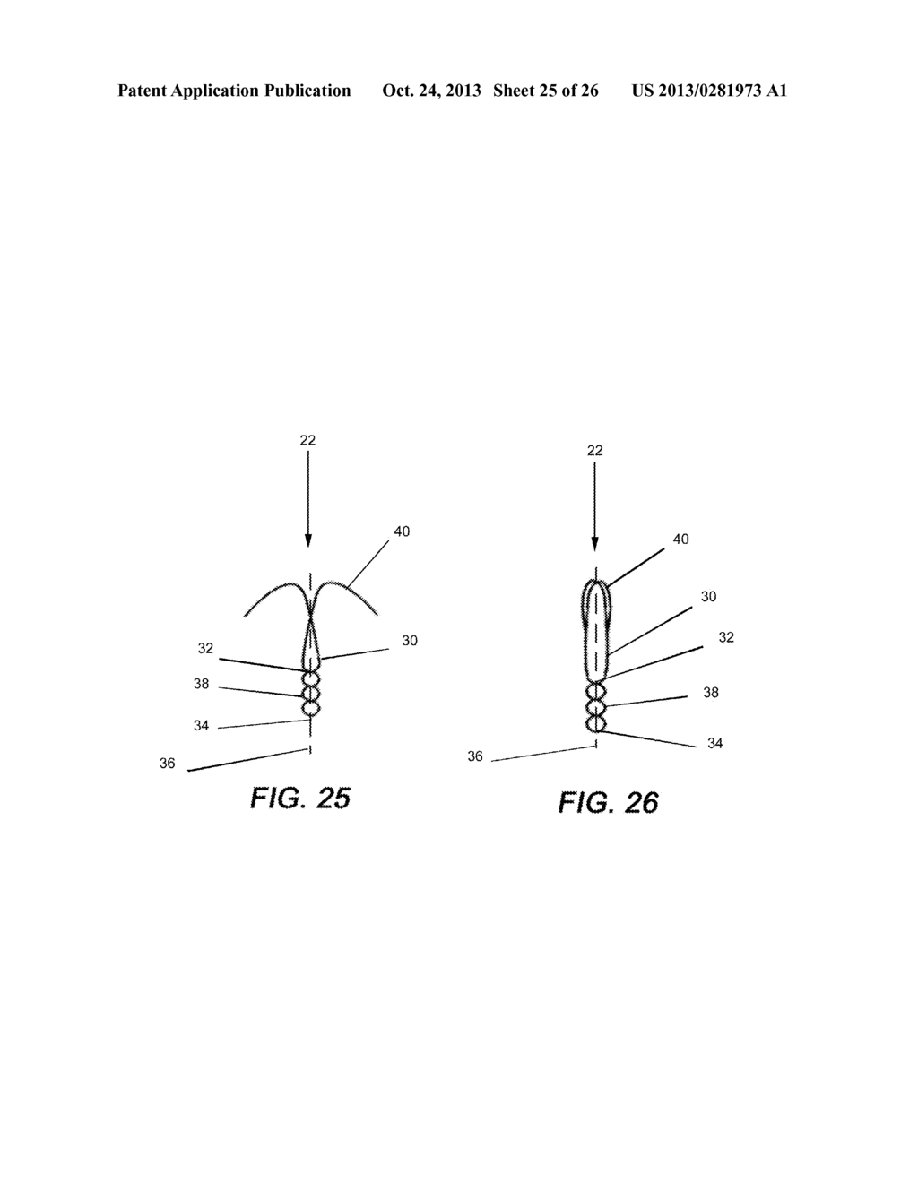 DEVICES AND METHODS FOR ANTERIOR ARYTENOID ADDUCTION - diagram, schematic, and image 26