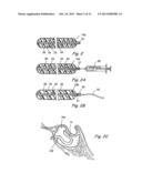 IMPLANTABLE DEVICES AND METHODS FOR DELIVERING DRUGS AND OTHER SUBSTANCES     TO TREAT SINUSITIS AND OTHER DISORDERS diagram and image