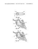 IMPLANTABLE DEVICES AND METHODS FOR DELIVERING DRUGS AND OTHER SUBSTANCES     TO TREAT SINUSITIS AND OTHER DISORDERS diagram and image