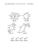 ENDOLUMINAL FILTER diagram and image