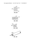 ENDOLUMINAL FILTER diagram and image