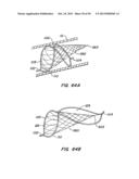 ENDOLUMINAL FILTER diagram and image