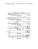 ENDOLUMINAL FILTER diagram and image