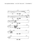 ENDOLUMINAL FILTER diagram and image