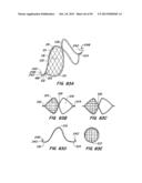 ENDOLUMINAL FILTER diagram and image