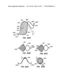 ENDOLUMINAL FILTER diagram and image