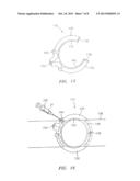 EXTRALUMINAL SEALANT APPLICATOR AND METHOD diagram and image