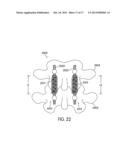 Dynamic Stabilization Systems And Devices For A Spine diagram and image