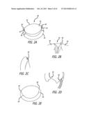 VALVE REPLACEMENT SYSTEMS AND METHODS diagram and image