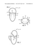 VALVE REPLACEMENT SYSTEMS AND METHODS diagram and image