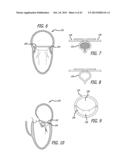 VALVE REPLACEMENT SYSTEMS AND METHODS diagram and image