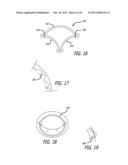 VALVE REPLACEMENT SYSTEMS AND METHODS diagram and image