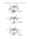 VALVE REPLACEMENT SYSTEMS AND METHODS diagram and image