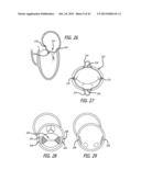 VALVE REPLACEMENT SYSTEMS AND METHODS diagram and image