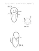 VALVE REPLACEMENT SYSTEMS AND METHODS diagram and image