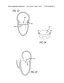 VALVE REPLACEMENT SYSTEMS AND METHODS diagram and image