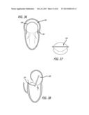 VALVE REPLACEMENT SYSTEMS AND METHODS diagram and image