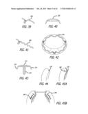 VALVE REPLACEMENT SYSTEMS AND METHODS diagram and image