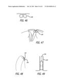 VALVE REPLACEMENT SYSTEMS AND METHODS diagram and image