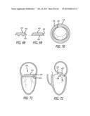 VALVE REPLACEMENT SYSTEMS AND METHODS diagram and image