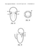 VALVE REPLACEMENT SYSTEMS AND METHODS diagram and image