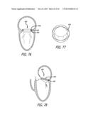 VALVE REPLACEMENT SYSTEMS AND METHODS diagram and image