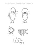 VALVE REPLACEMENT SYSTEMS AND METHODS diagram and image