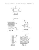 VALVE REPLACEMENT SYSTEMS AND METHODS diagram and image