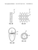 VALVE REPLACEMENT SYSTEMS AND METHODS diagram and image