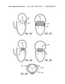 VALVE REPLACEMENT SYSTEMS AND METHODS diagram and image