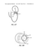 VALVE REPLACEMENT SYSTEMS AND METHODS diagram and image